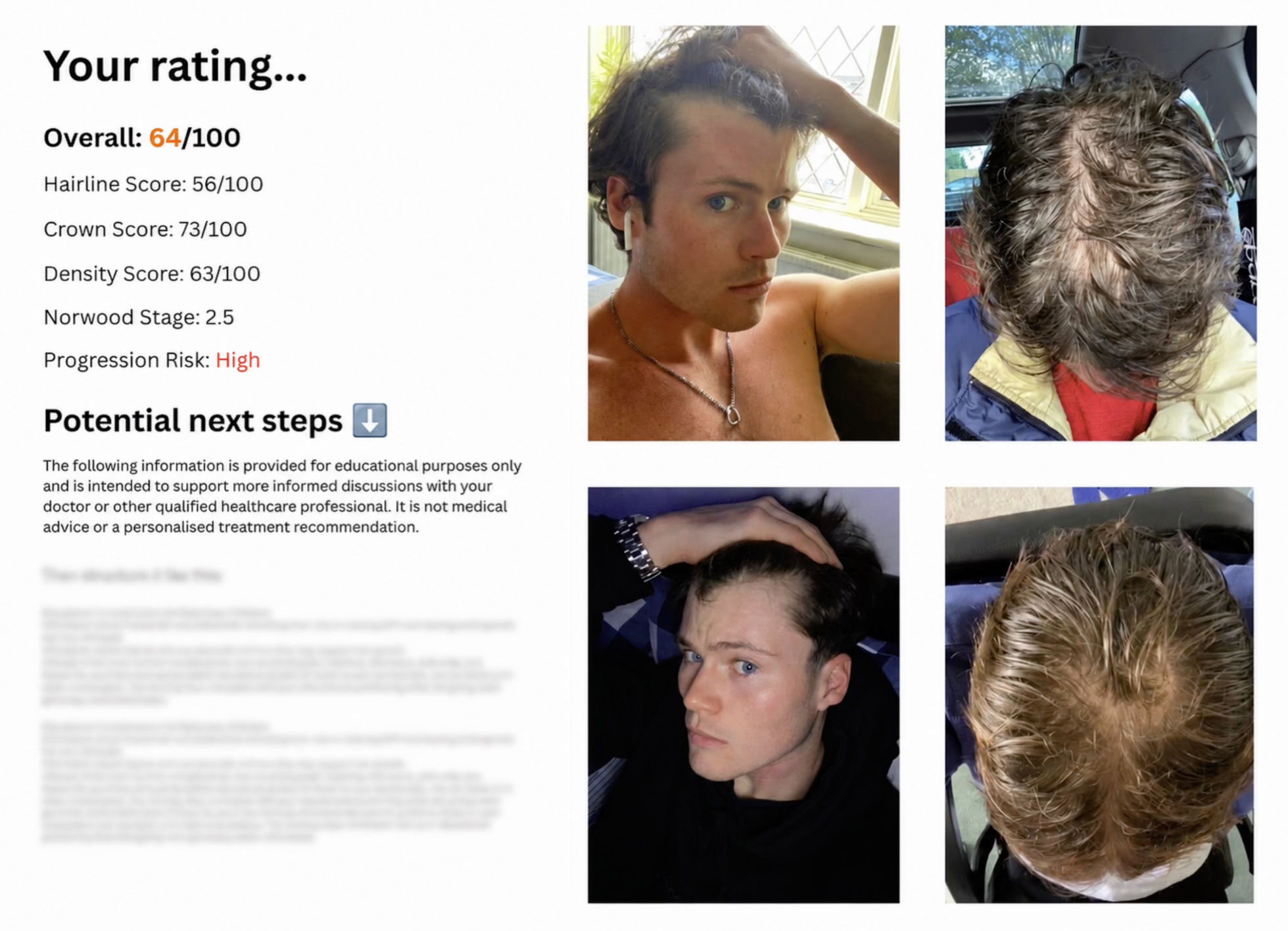 Example Hair Loss Rating report showing overall score, category breakdown, Norwood stage, progression risk and next steps alongside the submitted photos.